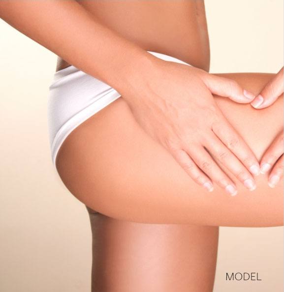 Cellulaze<sup/>™ helps smooth cellulite on the thighs and buttocks