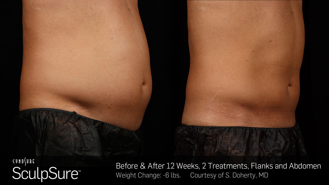 SculpSure Before & After