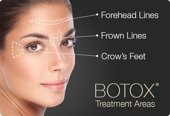 Botox Treatment Areas