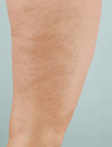 Before & After Cellulaze™ Treatments