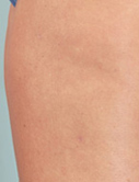 Before & After Cellulaze™ Treatments