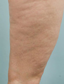 Before & After Cellulaze™ Treatments