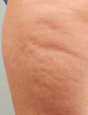 Before & After Cellulaze™ Treatments