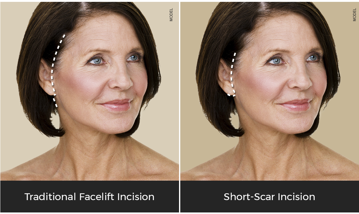 facelift incision graphic