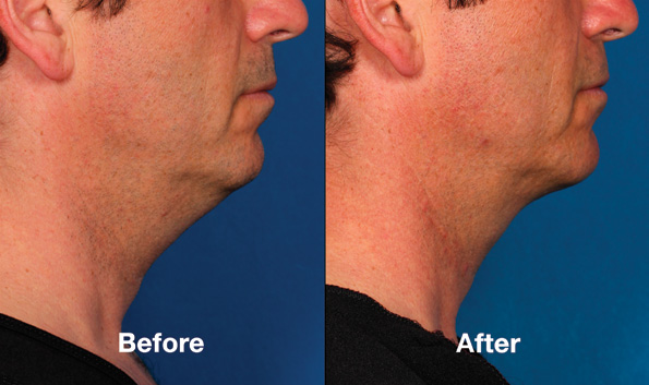 Kybella Before & After on man's chin/neck