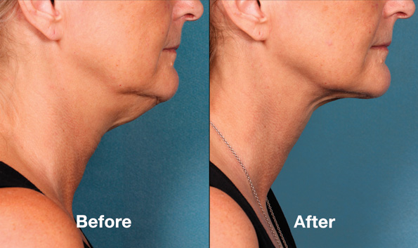 Kybella Before & After on woman's' chin/neck
