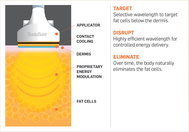 The SculpSure procedure