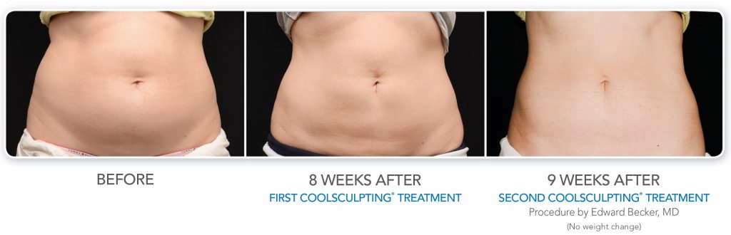 Patient Stomach Before and After Coolsculpting treatment
