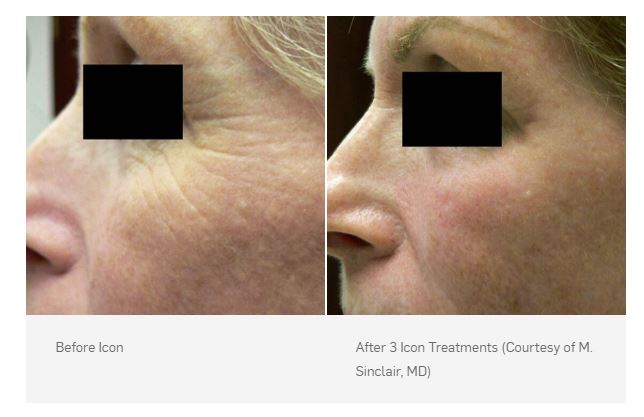 Before and After 3 Icon treatments (Courtesy of M. Sinclair, MD)