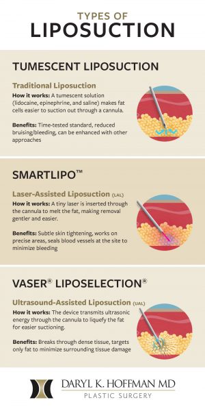 Infographic comparing types of liposuction, including tumescent, Smartlipo, and VASER