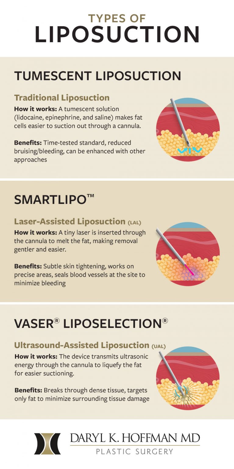 3 Different Types of Liposuction Which Is Best for You? (Infographic
