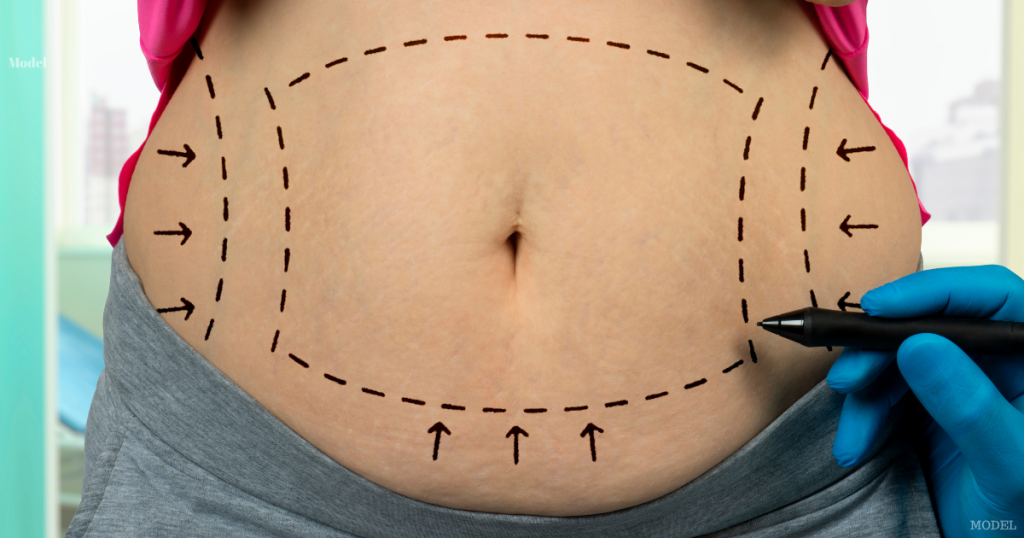 Patient body outline for liposuction treatment