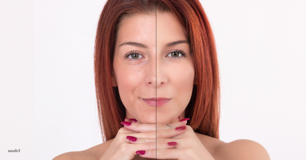 a close up image of a woman before and after a dermal fillers procedure (model)
